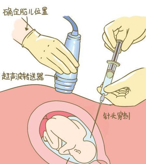 舟山羊水孕期亲子鉴定